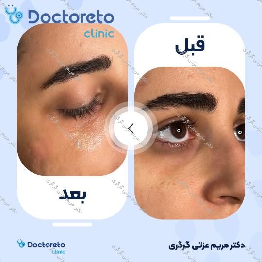 تزریق ژل زیر چشم با برند آلیاکسین (1CC)