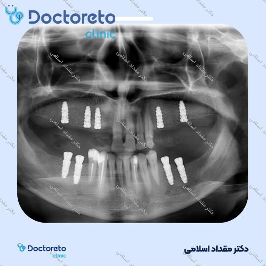 ایمپلنت نئودنت سوئیسی با روکش ( هرواحد ) دکتر مقداد اسلامی در تهران 12