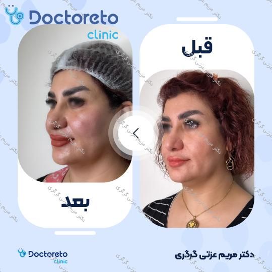 تزریق ژل گونه با برند پرفکتا (1CC) دکتر مریم عزتی گرگری در تهران 3