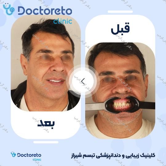 ایمپلنت دیجیتال دنتیس کره ای بدون روکش (هر واحد)