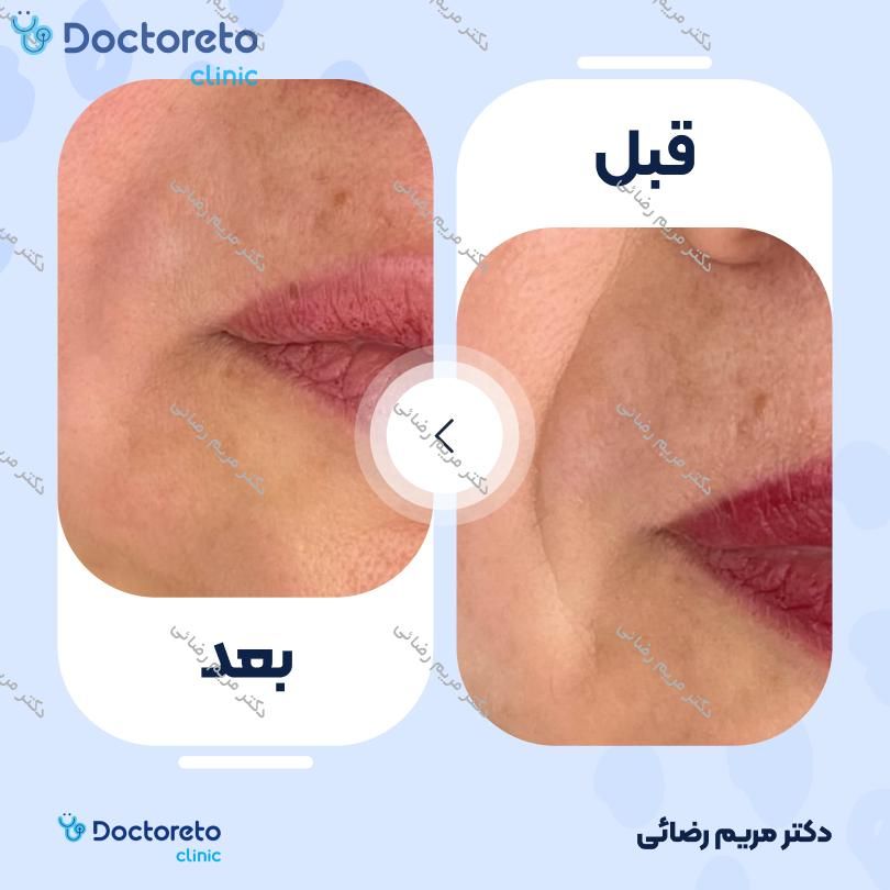 تزریق ژل خط خنده با برند نورامیس (1cc)