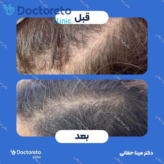 مزوتراپی موی سر با برند مزوتک (1cc) دکتر مینا حقانی در اصفهان 3