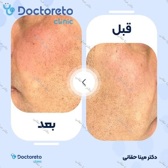 تزریق ژل گونه با برند رووفیل (1CC) دکتر مینا حقانی در اصفهان 9