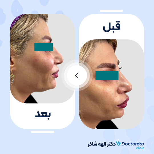 تزریق ژل گونه با برند استایلج (1CC)