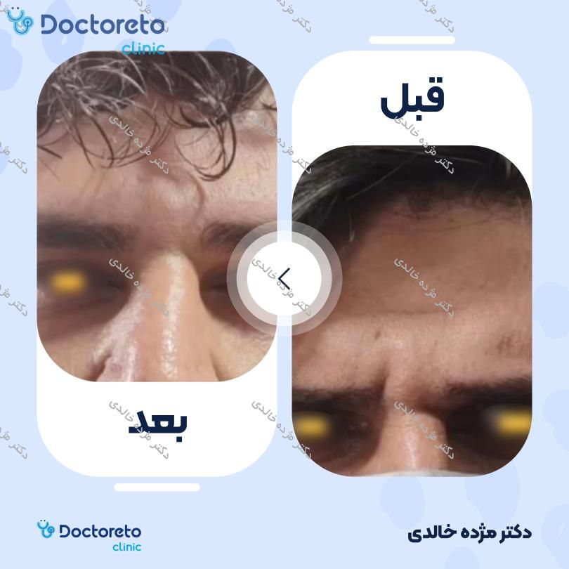 تزریق بوتاکس صورت (پیشانی، خط اخم، پنجه کلاغی) با برند مصپورت