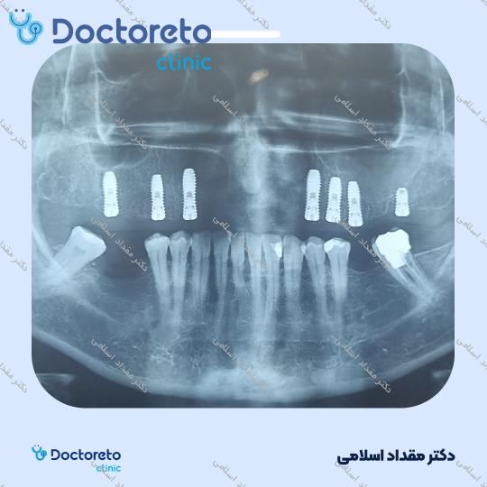 ایمپلنت نئودنت سوئیسی با روکش ( هرواحد ) دکتر مقداد اسلامی در تهران 8