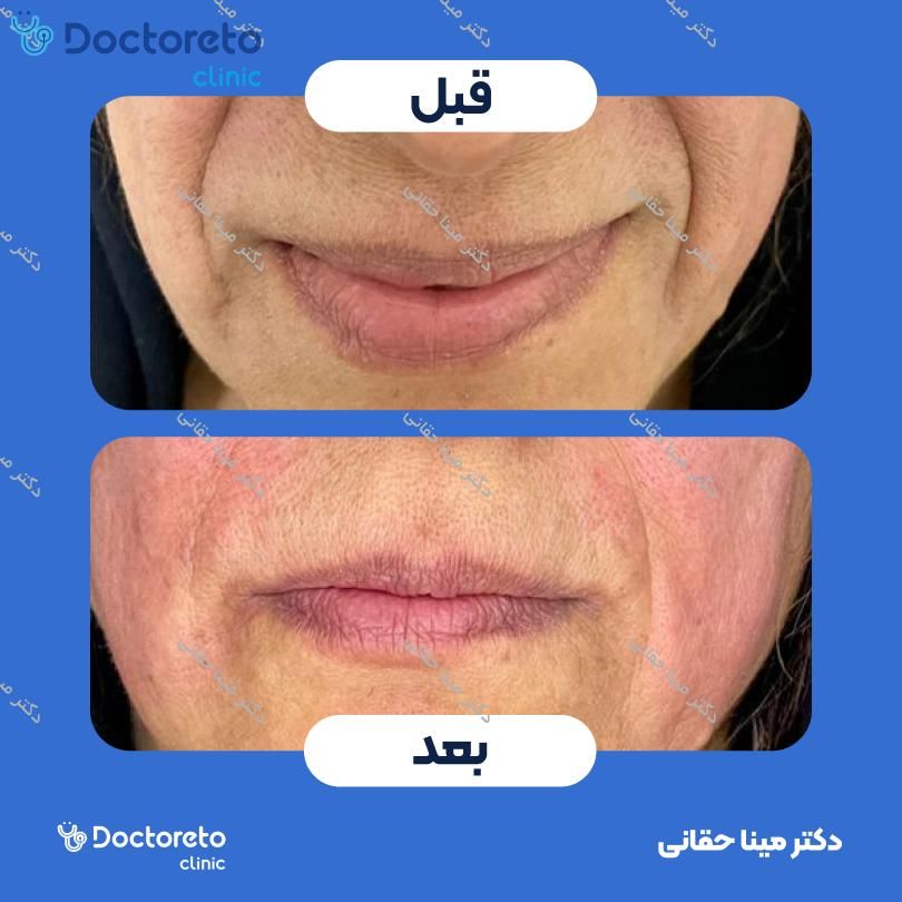 تزریق ژل خط خنده با برند آلیاکسین (1CC) دکتر مینا حقانی در اصفهان 3