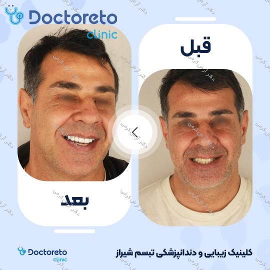 ایمپلنت دیجیتال دنتیس کره ای بدون روکش (هر واحد) دکتر آرش کرمی در شیراز 20