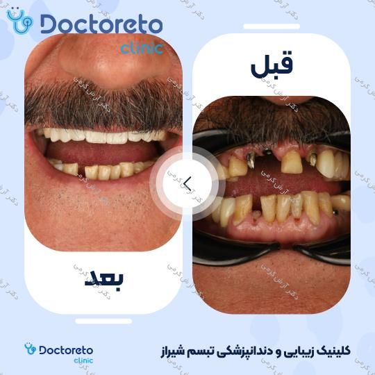 ایمپلنت دیجیتال دنتیس کره ای با روکش (هر واحد) دکتر آرش کرمی در شیراز 50