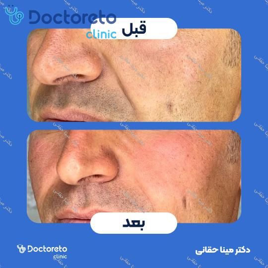 تزریق ژل گونه با برند آلکاریسا (1CC) دکتر مینا حقانی در اصفهان 4