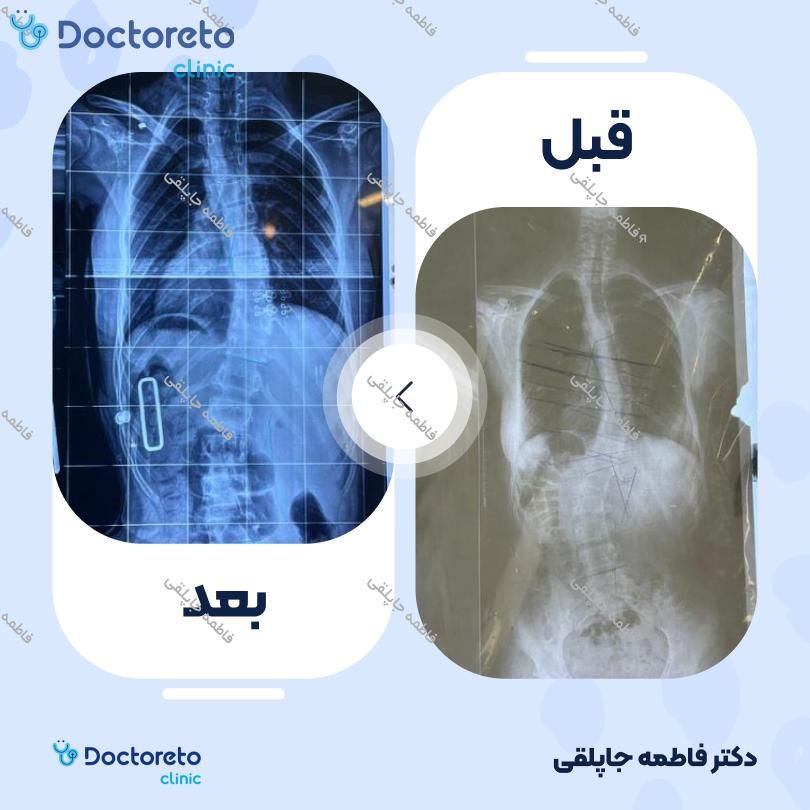 درمان انحراف لوردوز با کمربند طبی فاطمه جاپلقی در تهران 3