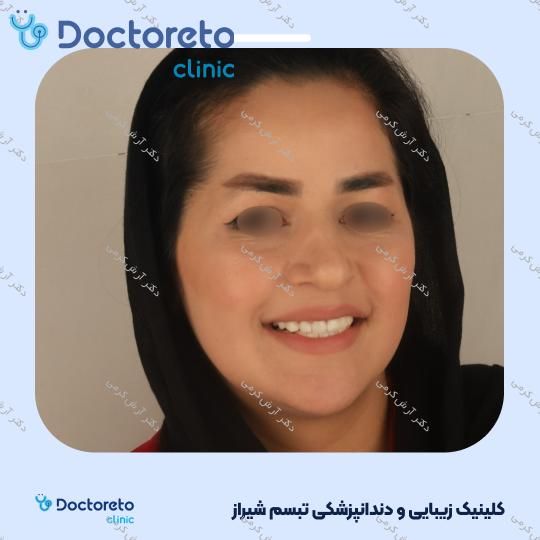 ایمپلنت دیجیتال دنتیس کره ای با روکش (هر واحد) دکتر آرش کرمی در شیراز 96