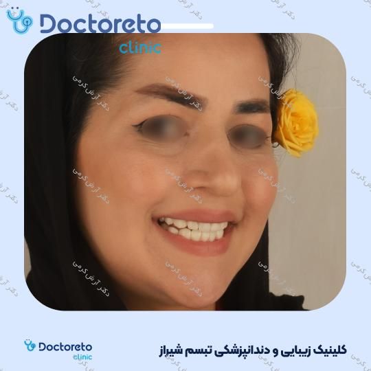 ایمپلنت دیجیتال دنتیس کره ای بدون روکش (هر واحد) دکتر آرش کرمی در شیراز 91