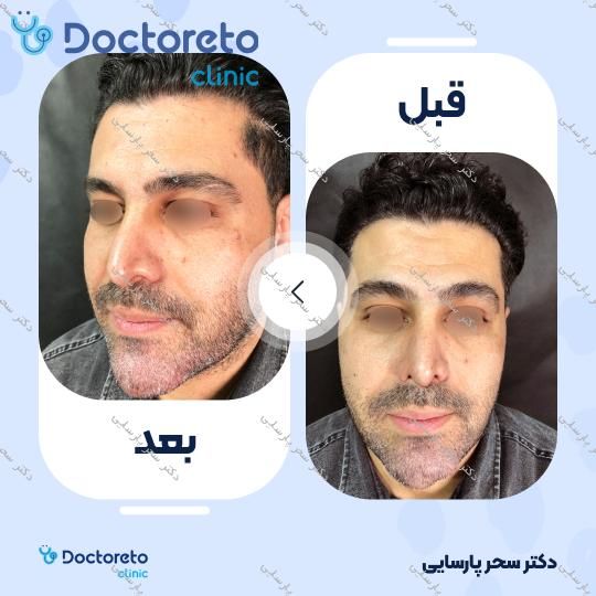 تزریق ژل چانه با برند پرفکتا (1CC) دکتر سحر پارسایی در مشهد 2