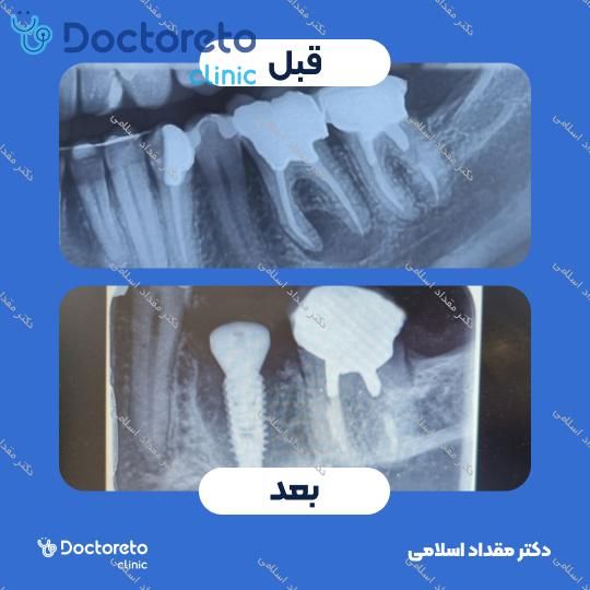 سینوس لیفت باز دکتر مقداد اسلامی در تهران 13