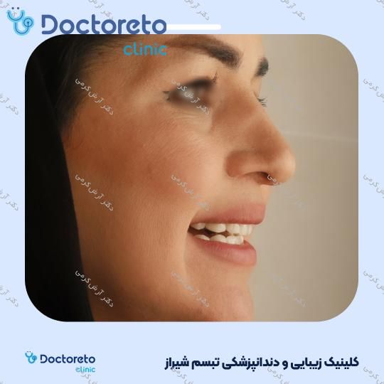 ایمپلنت دیجیتال dio کره ای با روکش (هر واحد) دکتر آرش کرمی در شیراز 74