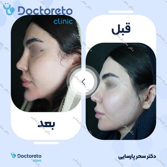 تزریق ژل چانه با برند نئوویا (1CC) دکتر سحر پارسایی در مشهد 4