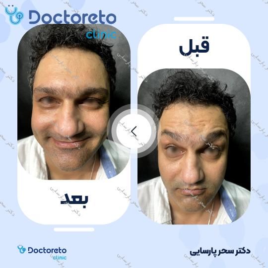 تزریق بوتاکس صورت (پیشانی، خط اخم، دور چشم) با برند مصپورت دکتر سحر پارسایی در مشهد 4