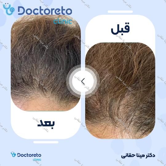 مزوتراپی موی سر با برند الپاژینا (2cc) دکتر مینا حقانی در اصفهان 2