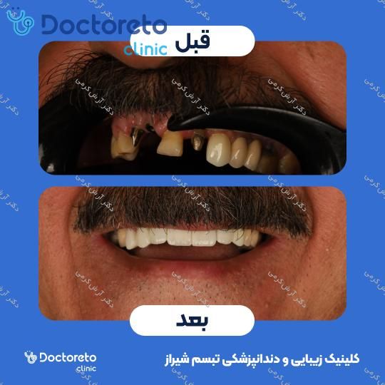 ایمپلنت دیجیتال دنتیس کره ای با روکش (هر واحد) دکتر آرش کرمی در شیراز 43