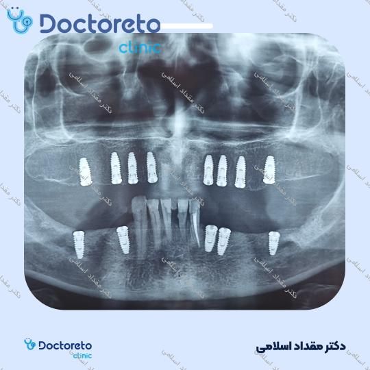 ایمپلنت اشترومن سوئیسی BLX active با روکش ( هرواحد ) دکتر مقداد اسلامی در تهران 7