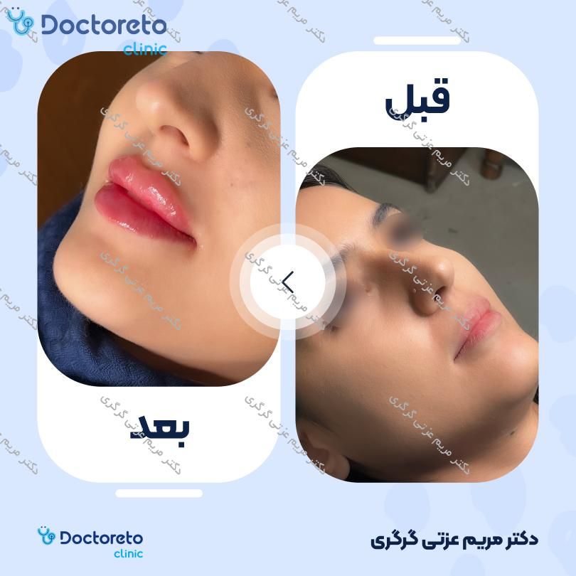 تزریق ژل لب با برند آلیاکسین (1CC) دکتر مریم عزتی گرگری در تهران 3