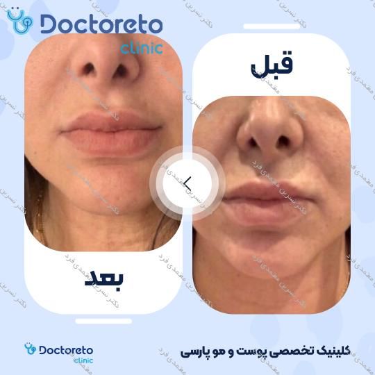 هایفوتراپی صورت و غبغب با دستگاه 7 بعدی اولترا (هر جلسه) دکتر نسرین معتمدی فرد در اصفهان 4