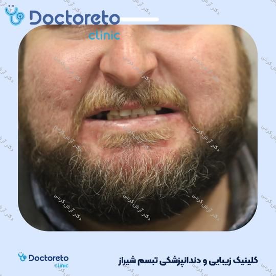 ایمپلنت دیجیتال دنتیس کره ای با روکش (هر واحد) دکتر آرش کرمی در شیراز 59