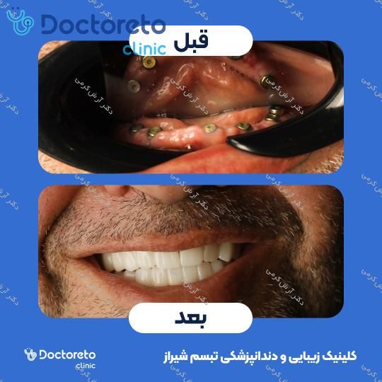 ایمپلنت دیجیتال dio کره ای با روکش (هر واحد) دکتر آرش کرمی در شیراز 122