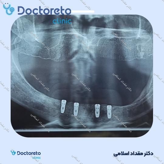 ایمپلنت اشترومن سوئیسی راکسالید با روکش ( هرواحد ) دکتر مقداد اسلامی در تهران 7