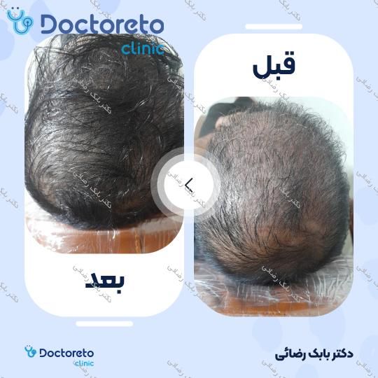 مزوتراپی موی سر با برند فیوژن (هر جلسه) دکتر بابک رضائی در مهران 6