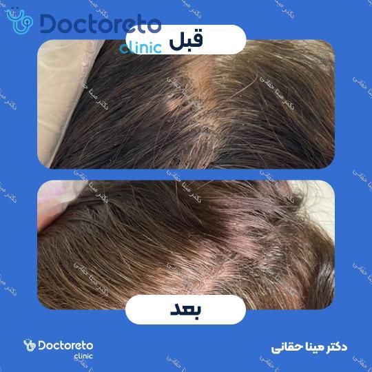 مزوتراپی موی سر با برند ام سی سی ام (1cc) دکتر مینا حقانی در اصفهان 4