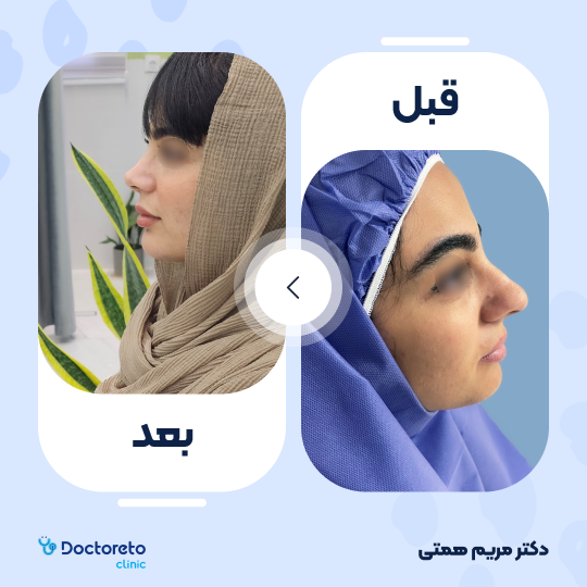 عمل زیبایی بینی (رینوپلاستی) دکتر مریم همتی در شیراز 7