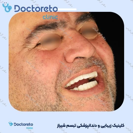 ایمپلنت دیجیتال دنتیس کره ای بدون روکش (هر واحد) دکتر آرش کرمی در شیراز 118