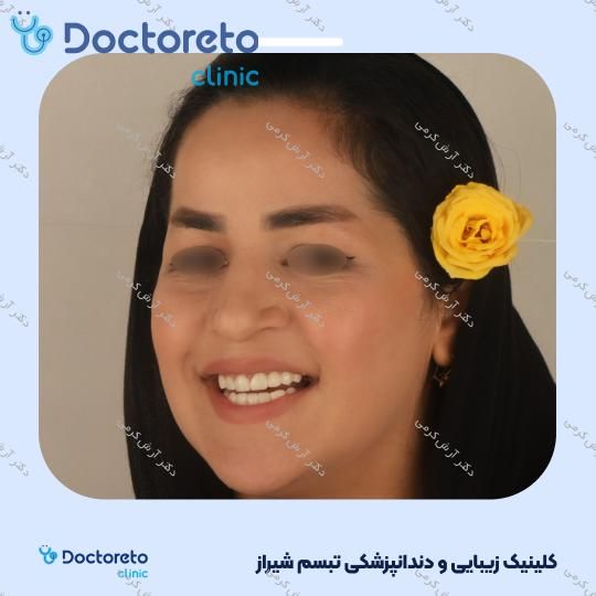 ایمپلنت دیجیتال dio کره ای با روکش (هر واحد) دکتر آرش کرمی در شیراز 89