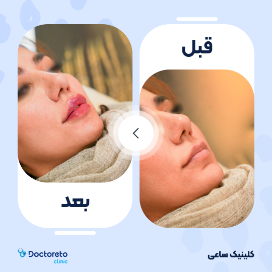 تزریق ژل لب با برند اینووسنس (1cc)