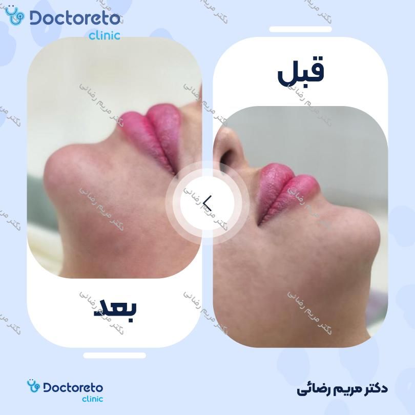 تزریق ژل چانه با برند ریوانس (1cc)