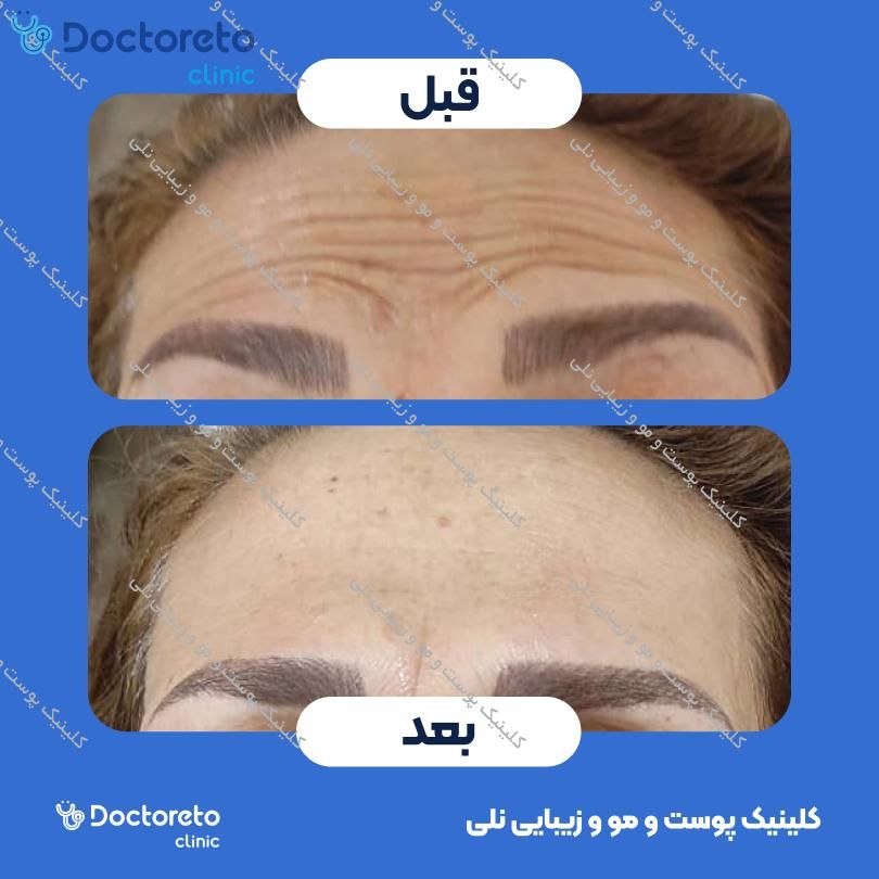 تزریق بوتاکس صورت (پیشانی، خط اخم، پنجه کلاغی) با برند دیستون کلینیک پوست و مو و زیبایی نلی در شیراز 5