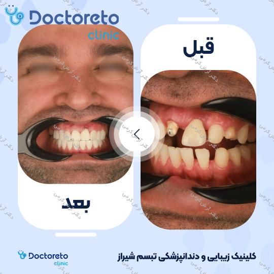 ایمپلنت دیجیتال دنتیس کره ای بدون روکش (هر واحد) دکتر آرش کرمی در شیراز 26