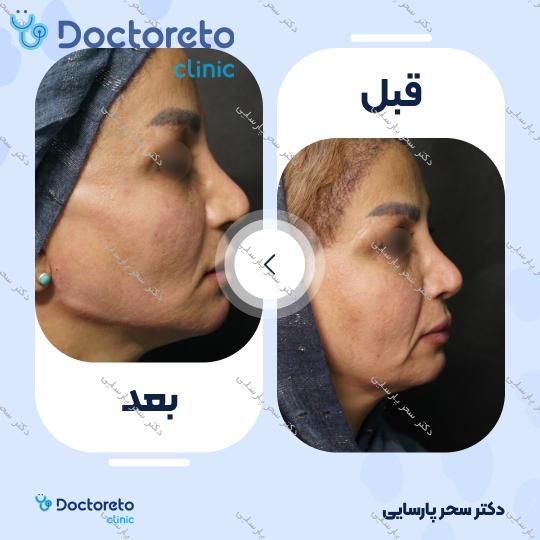 تزریق ژل زاویه فک با برند رووفیل (1CC) دکتر سحر پارسایی در مشهد 11