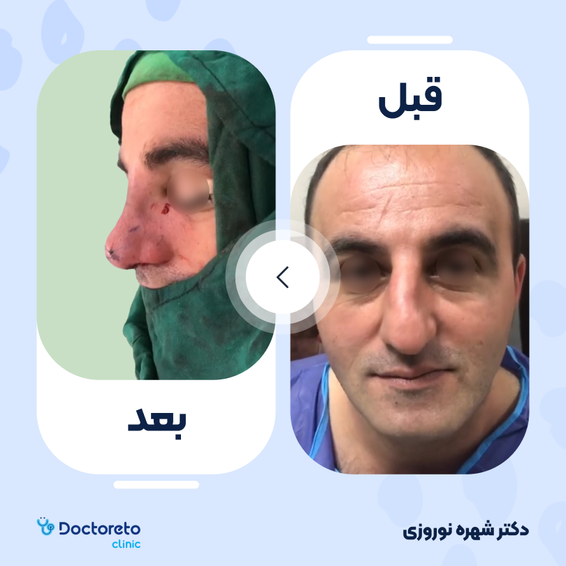 عمل زیبایی بینی (رینوپلاستی) دکتر شهره نوروزی در اهواز 4