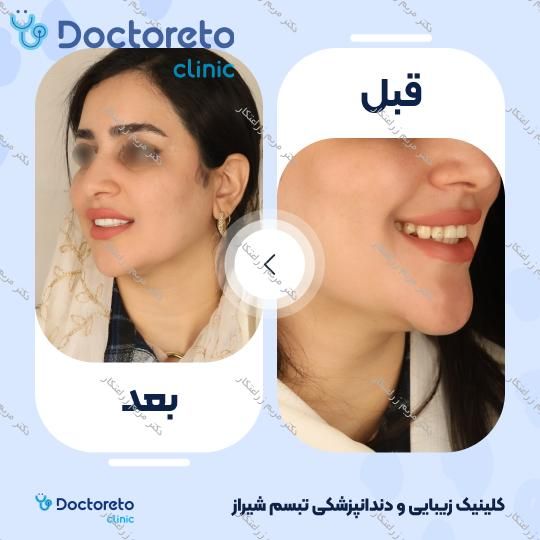 ونیر کامپوزیت توکویاما ژاپنی (هر واحد) دکتر مریم زراعتکار در شیراز 16