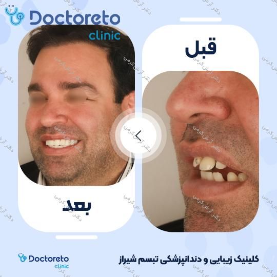 ایمپلنت دیجیتال dio کره ای با روکش (هر واحد) دکتر آرش کرمی در شیراز 29