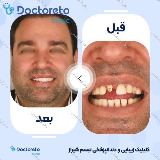 ایمپلنت دیجیتال dio کره ای با روکش (هر واحد) دکتر آرش کرمی در شیراز 32