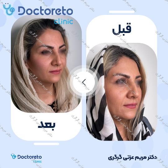 تزریق ژل گونه با برند پرفکتا (1CC) دکتر مریم عزتی گرگری در تهران 2