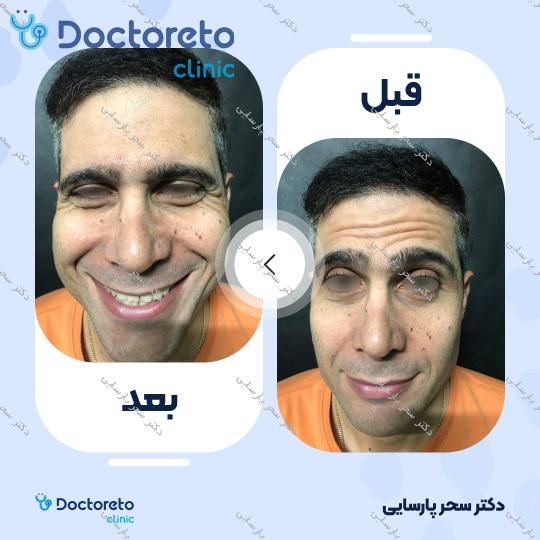 تزریق بوتاکس صورت (پیشانی، خط اخم، دور چشم) با برند دیسپورت دکتر سحر پارسایی در مشهد 4