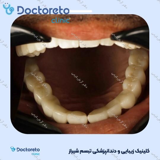 ایمپلنت دیجیتال اشترومن iti سوئیسی با روکش (هر واحد) دکتر آرش کرمی در شیراز 19