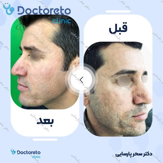 رفع جای جوش و آکنه به روش سابسیژن (هر جلسه)