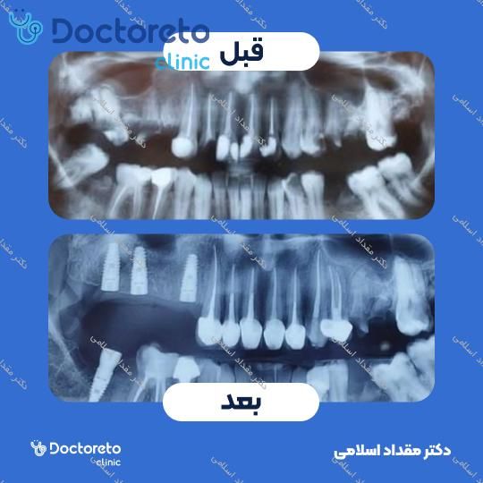 ایمپلنت کره ای DIO با روکش (هر واحد)