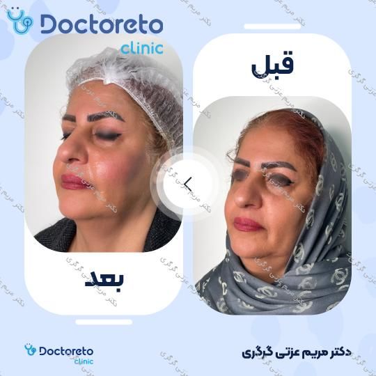 تزریق ژل گونه با برند پرفکتا (1CC)